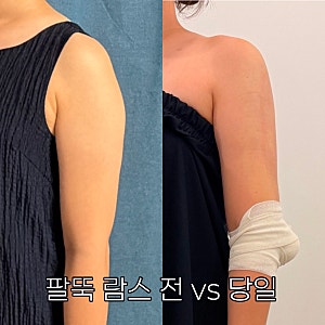 팔뚝 람스 당일 후기 2편｜시술 할 때 통증은? 과정부터 약물 흐름 대처 & 전후 비교