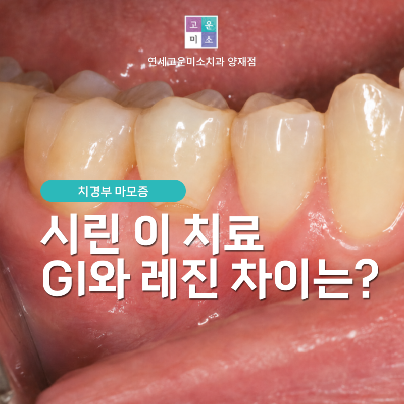 양재역치과 치경부 마모증 치료, GI와 레진 어떤 재료가 맞을까요?