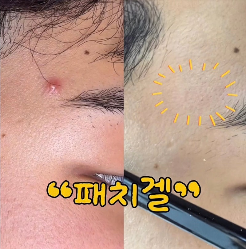 여드름 압출 후엔 꼭 바르는 패치겔 ”픽시카”로