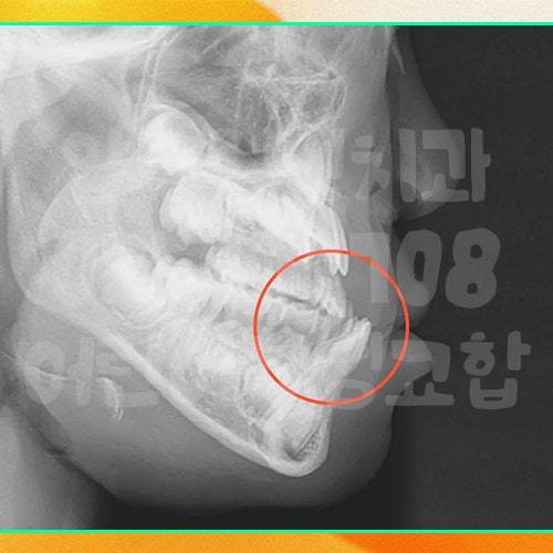 초등학생 부정교합 치료방법, 프랑켈이 가능해요