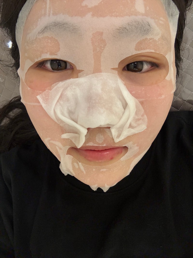 구진성? 비후성반흔? 피지선증식증? 켈로이드? 코 여드름 아그네스 치료