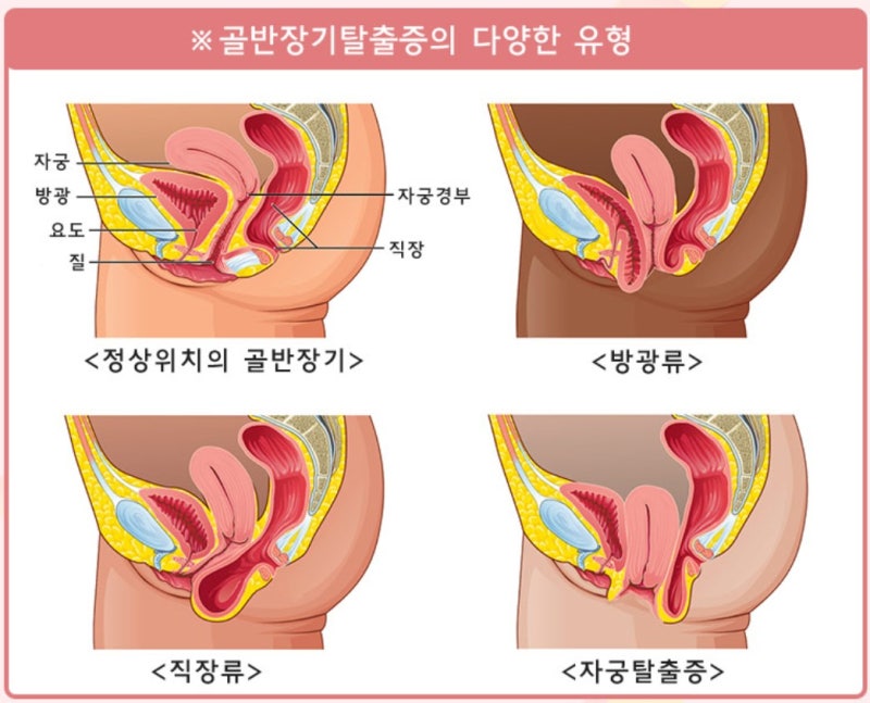 골반장기탈출증 Pelvic Organ Prolapse 과 방광탈출증·방광류 Cystocele 증상 총람