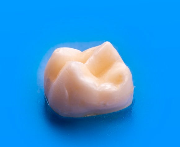치과 크라운 치료 비용, 재료 가격은 어떻게 다를까요?
