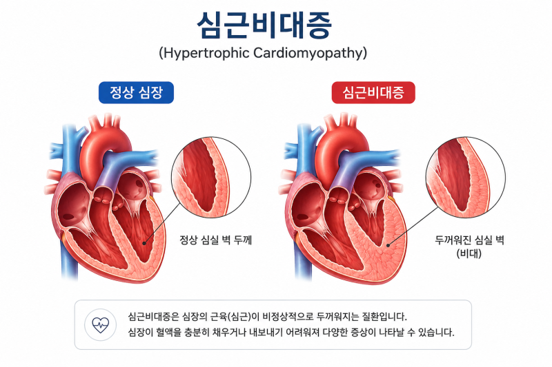 심근비대증, 뜻, 증상, 원인, 치료방법, 주의사항, 총정리