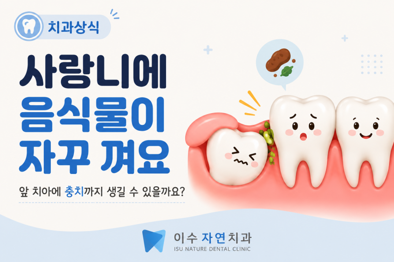 사랑니에 음식물이 자꾸 껴요, 앞 치아 충치까지 생긴 상악 매복사랑니 발치 사례