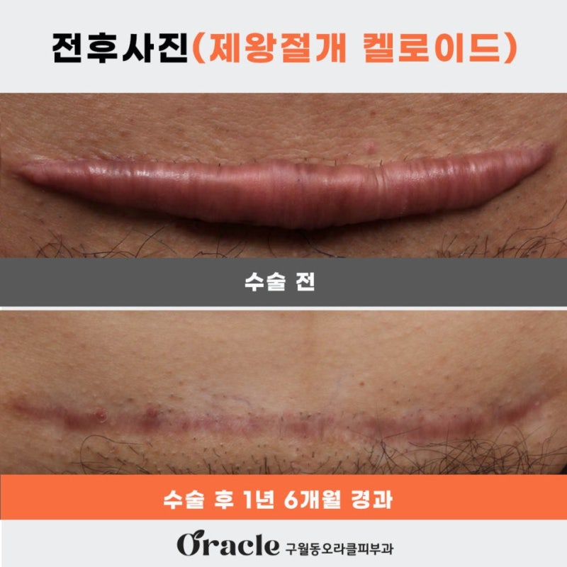 인천 구월동 오라클 피부과 켈로이드 원인과 치료 방법, 귀 피어싱 후 살튀가 생겼다면?