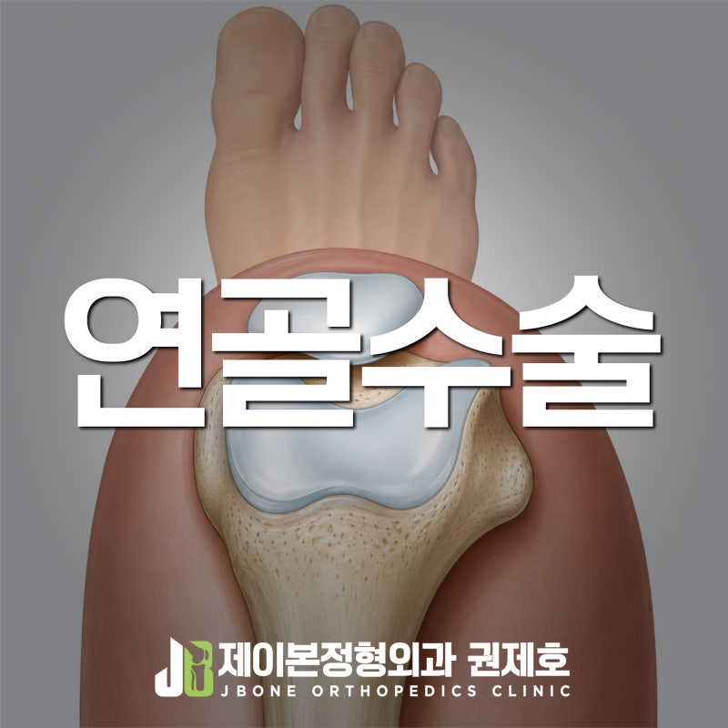 무릎연골수술, 걷기는 되는데 뛰지 못했던 활차구연골결손
