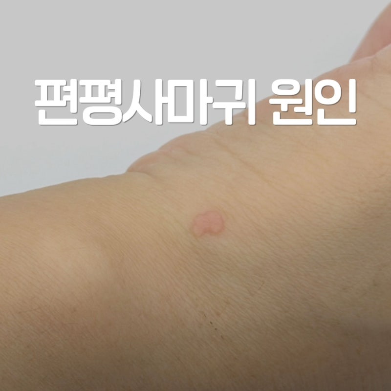 사마귀 원인 HPV바이러스 때문일까? 전염성, 제거방법