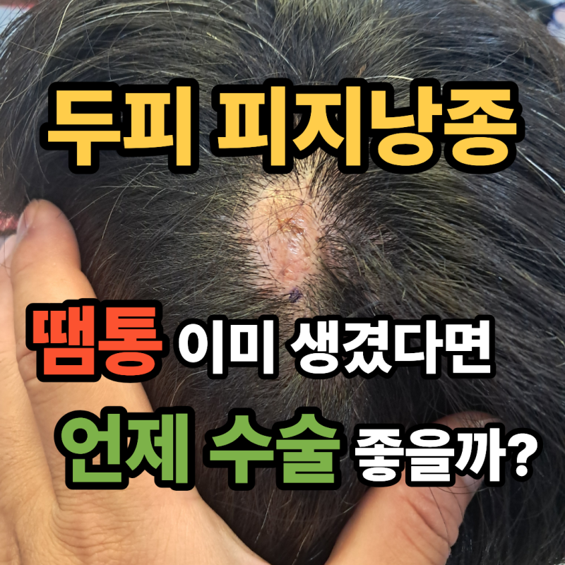 두피 피지낭종 염증 때문에 땜통까지? 수술을 미루면 안 되는 이유