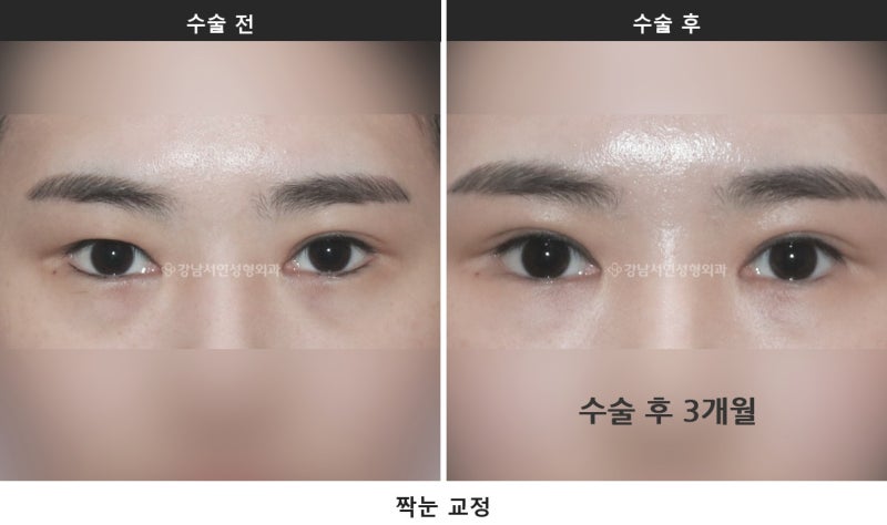짝눈 쌍수 재수술, 한쪽만 고쳐도 될까? 원인별로 다른 이유