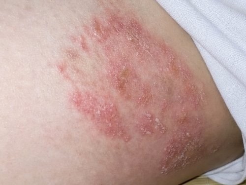 남자 자주 생기는 사타구니 짓무름 가려움 보습제로 케어해도 될까?