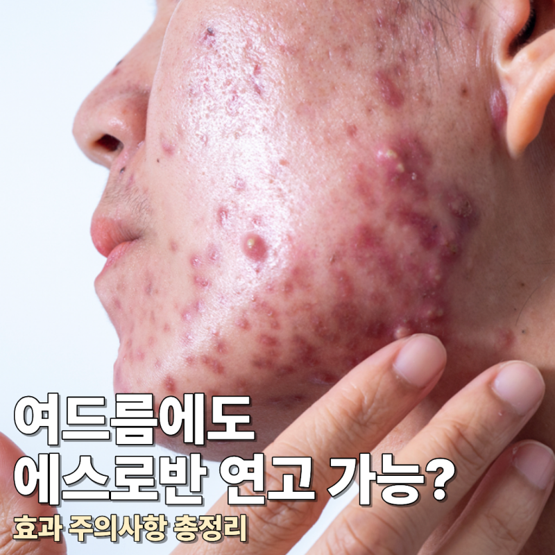 여드름에도 에스로반 연고 발라도 돼? 효과 주의사항 총정리
