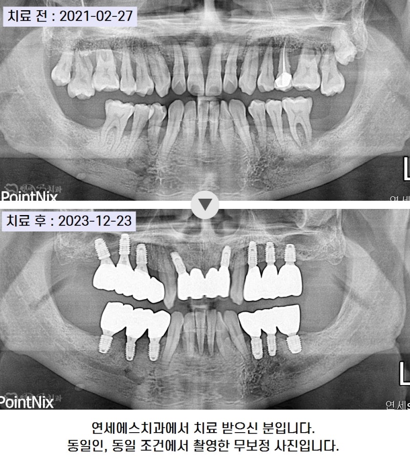 어금니 잇몸 부종 부음 피, 약 진통제 말고 치료