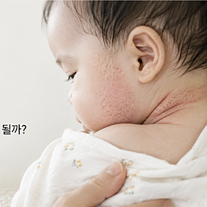 아기 땀띠 없애는법, 목 땀띠 수딩젤 연고 발라도 될까?