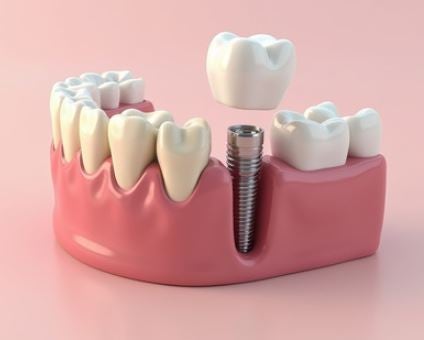 전주보가치과의원｜치과임플란트 수가 및 산정방법 FAQ - 2