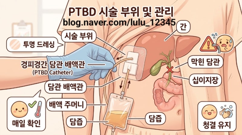 30대 췌장암 이겨내기_ PTBD는 무엇인가요?