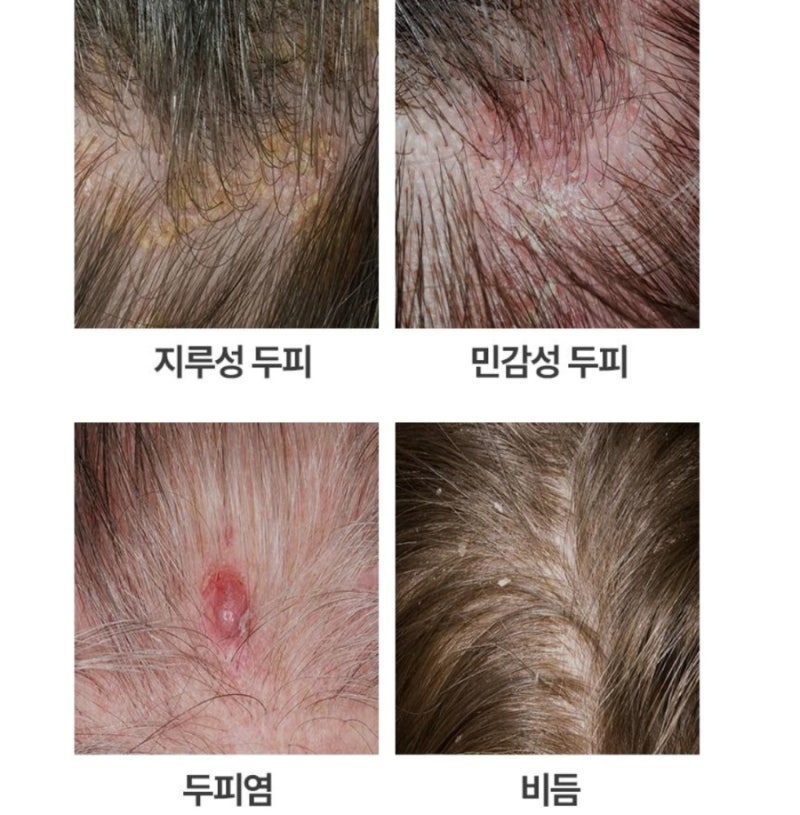 비듬이 계속 생긴다면? 니조랄 말고 이것도 있다 덴드로프쿨액 비가졸 샴푸
