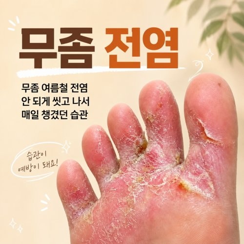 무좀 여름철 전염 안 되게 씻고 나서 매일 챙겼던 습관