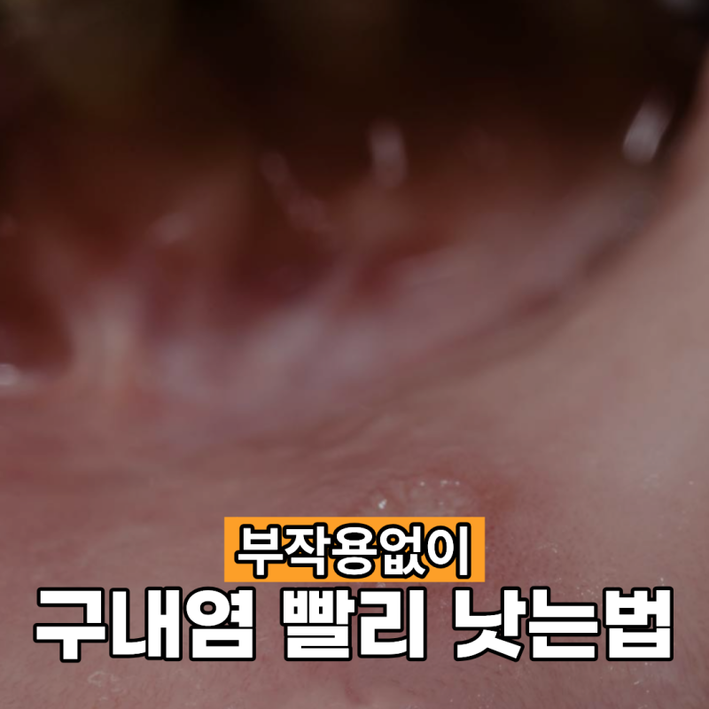 구내염 빨리 낫는법 부작용 없이 관리하려면?