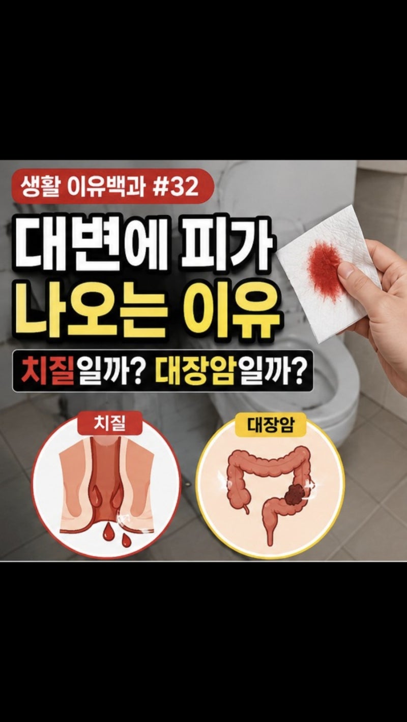 대변에 피가 나오는 이유, 치질일까 대장암일까?｜생활 이유백과 #32