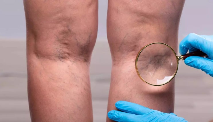 10만원부터 1700만원까지… 하지정맥류 치료비 천차만별, 왜?