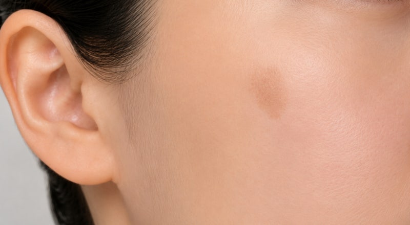함익병 기미크림 효과 멜라논크림 처방 연고 후기