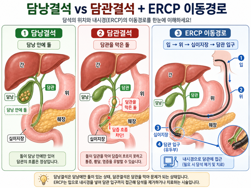 [시화병원 메디프렌즈 서포터즈 1기 활동] 담낭에 돌이 있는데 왜 입으로 내시경을 넣을까요?....