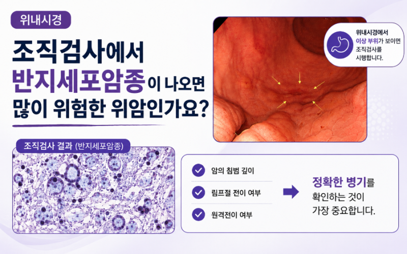 건강검진 위내시경 조직검사에서 반지세포암종이 나오면 많이 위험한 위암인가요? 건강검진....