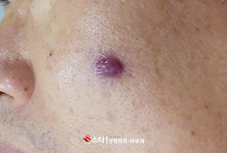 서울 혈관종제거, 무조건 없애기보다 먼저 상태를 확인해야 합니다