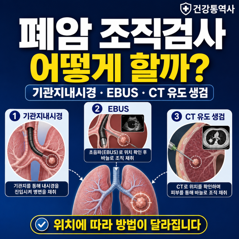 폐암 조직검사는 어떻게 할까? 기관지내시경·EBUS·CT 유도 생검 차이
