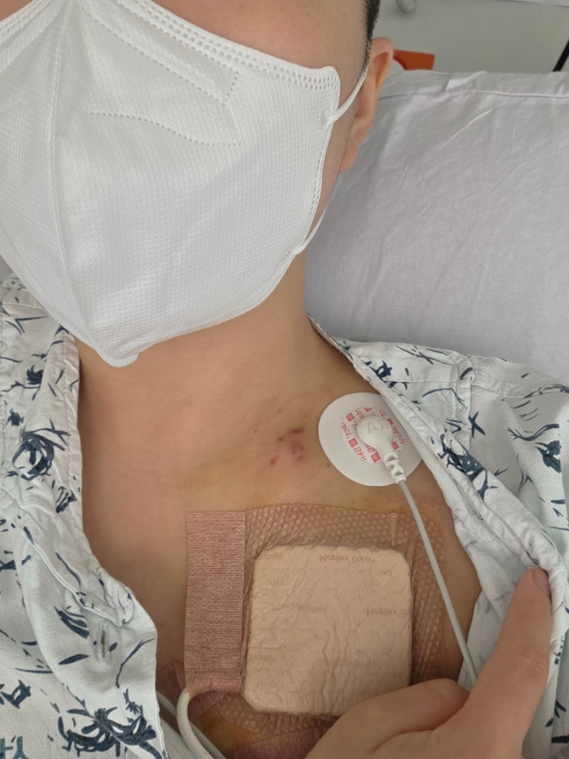 무균실 조혈모세포이식후기 골수이식후기 케모포트후기 골수이형성증후군