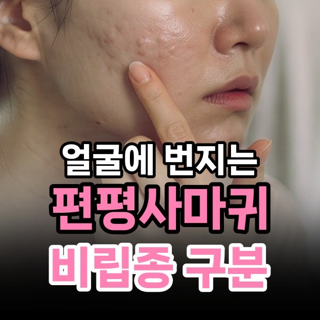 오돌토돌 얼굴 편평사마귀인지 비립종인지 제거 방법 고민이라면?
