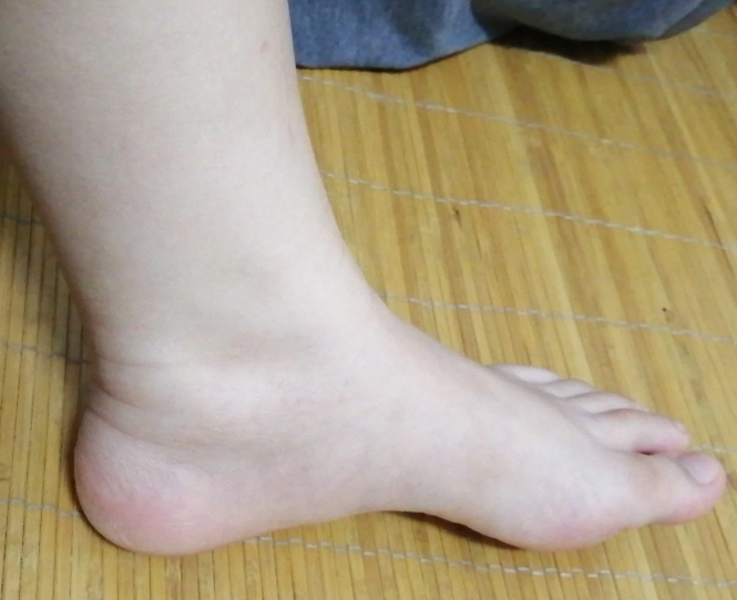 발목 테이핑 보호대 붙이는 방향에 따라 효과 달라요