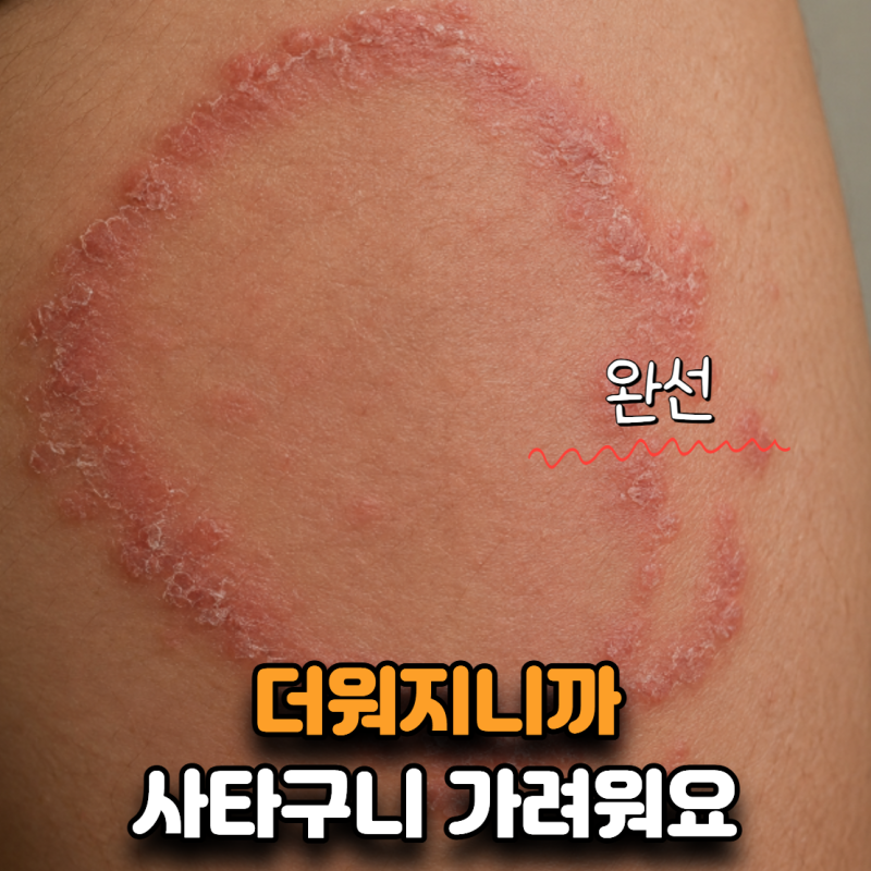 “더워지니 사타구니가 자꾸 가려워요” 사타구니 완선, 연고 며칠 발라야 할까?