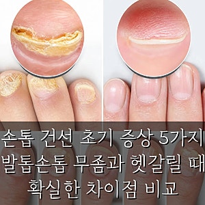 손톱 건선 초기 증상 5가지 발톱 손톱 무좀과 헷갈릴 때 확실한 차이점 비교