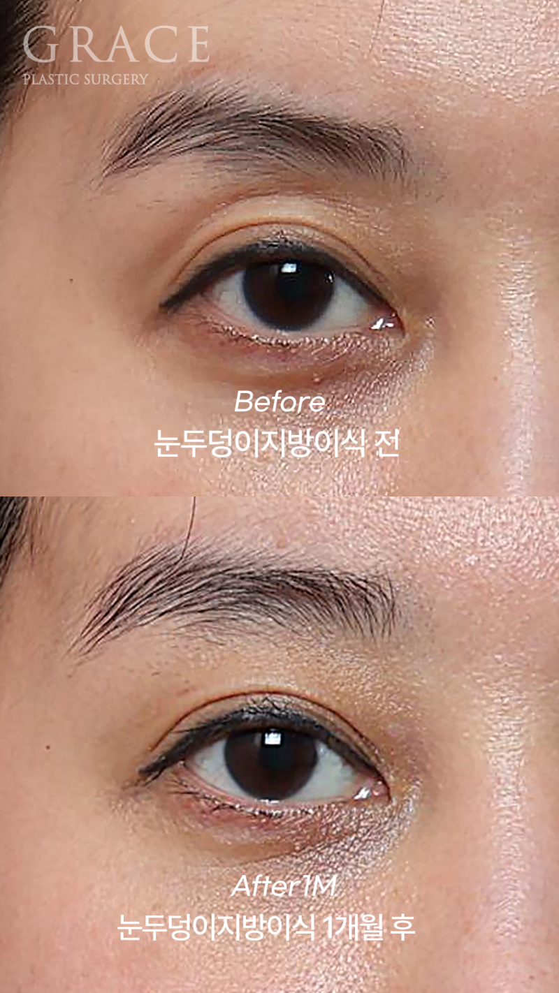 아이홀 지방이식 부작용 잘하는 곳은 뭐가 다를까?