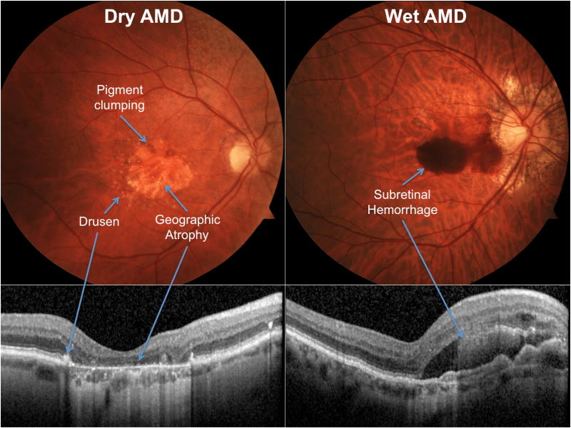 황반변성(macular degeneration)