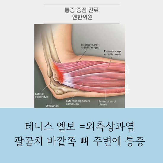 역삼역 팔꿈치 통증, '테니스 엘보' 원인부터 예방법까지 총정리