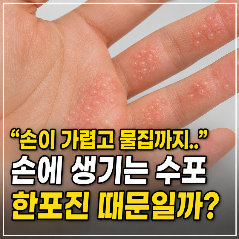 손이 가렵고 수포가 생기는 이유 한포진 증상과 원인