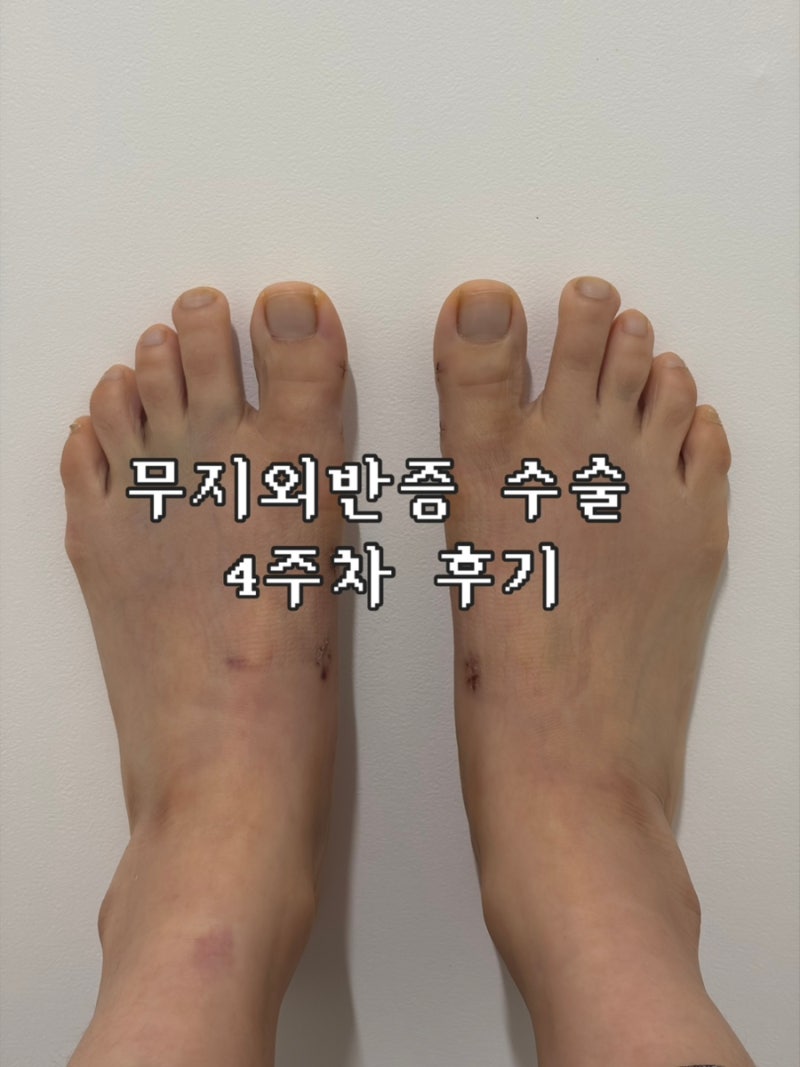 무지외반증 수술 4주차 후기