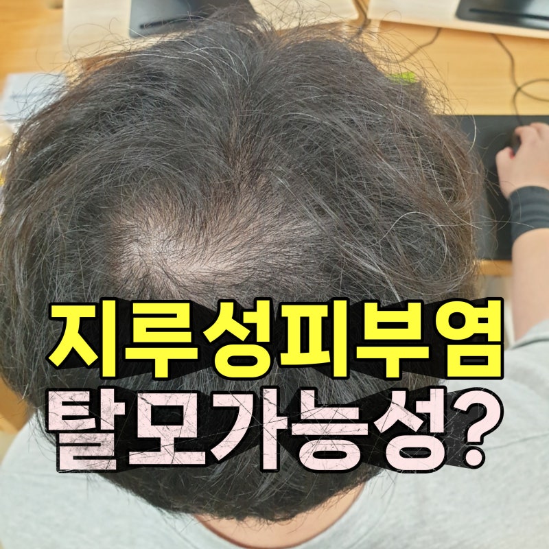 지루성 피부염 얼굴과 두피 가려움 방치하면 탈모까지?