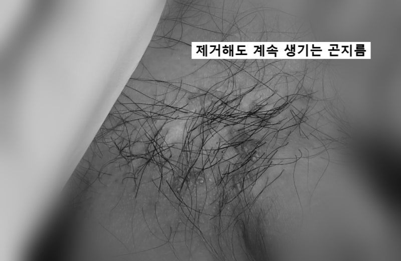 남자 곤지름 재발, 반복하면 완치가 어렵다고요?