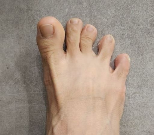 엄지발가락 힘줄이 아플 때, 발등과 발바닥 통증 위치로 원인을 구분할 수 있을까?