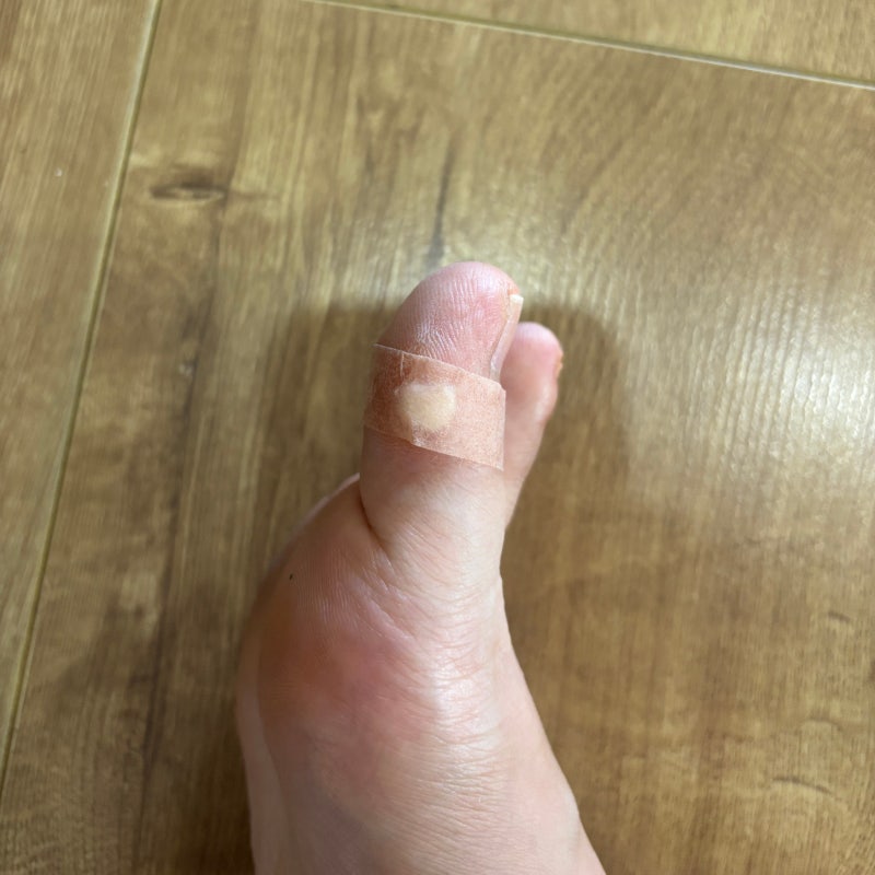 발가락 족저사마귀 원인, 식초로 제거될까? 발 사마귀 치료 방법