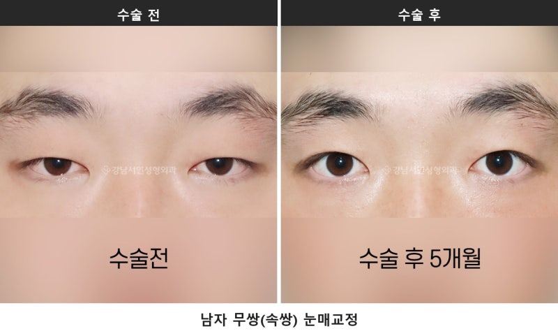 남자 무쌍 눈매교정, 부작용 없이 자연스럽게 될 수 있을까? 여자와 다른 이유