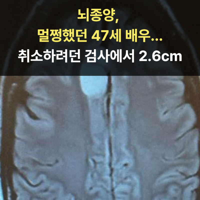 뇌종양, 멀쩡했던 47세 배우...취소하려던 검사에서 2.6cm