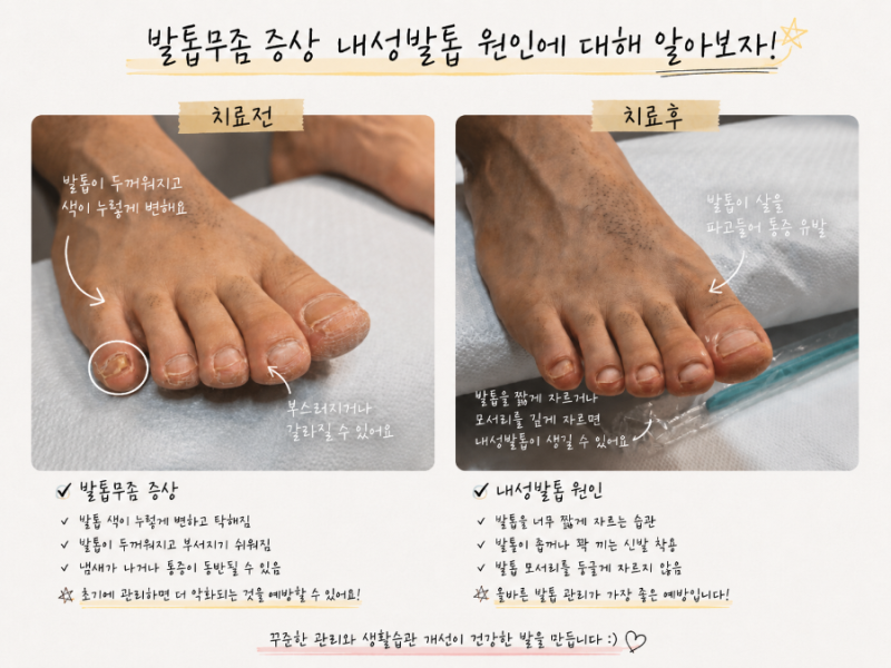 인천발톱무좀 내성발톱, 증상과 원인 한눈에 알아보기