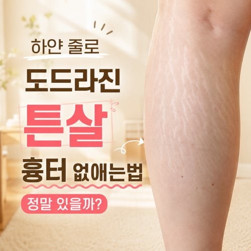 하얀 줄로 도드라진 튼살 흉터 없애는법 정말 있을까?