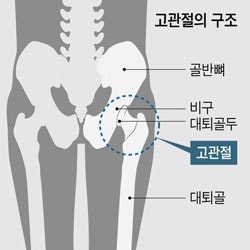 고관절충돌증후군 증상 원인 자가진단 치료 순서