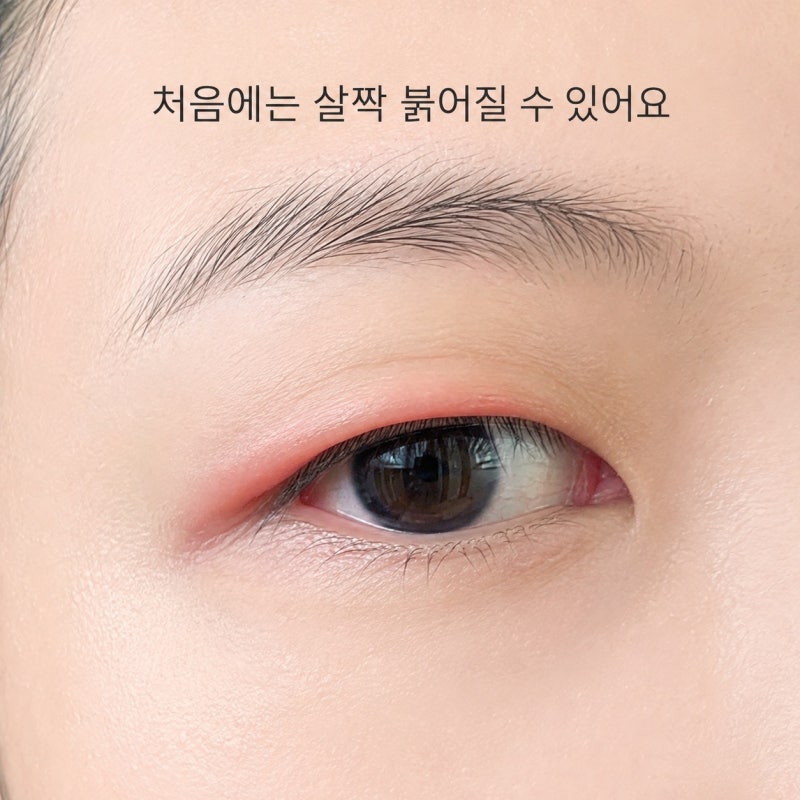 다래끼초기증상 5가지, 눈꺼풀이 붓기 전 이런 느낌부터 와요